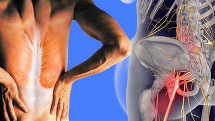 При ишиасе для лечения нужен ортопедический пояс для спины с ребрами жесткости
