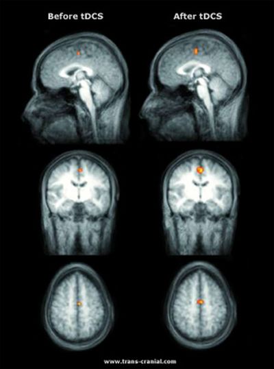 Изображение мозга (слева) и после (справа) транскраниальной стимуляции в ходе простого движения – постукивания пальцами по крышке стола. Стимуляция повысила активность нейронов на 40%